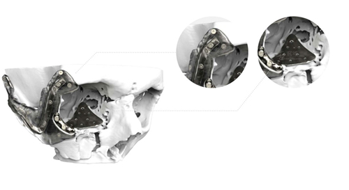 3D打印在医疗行业的应用